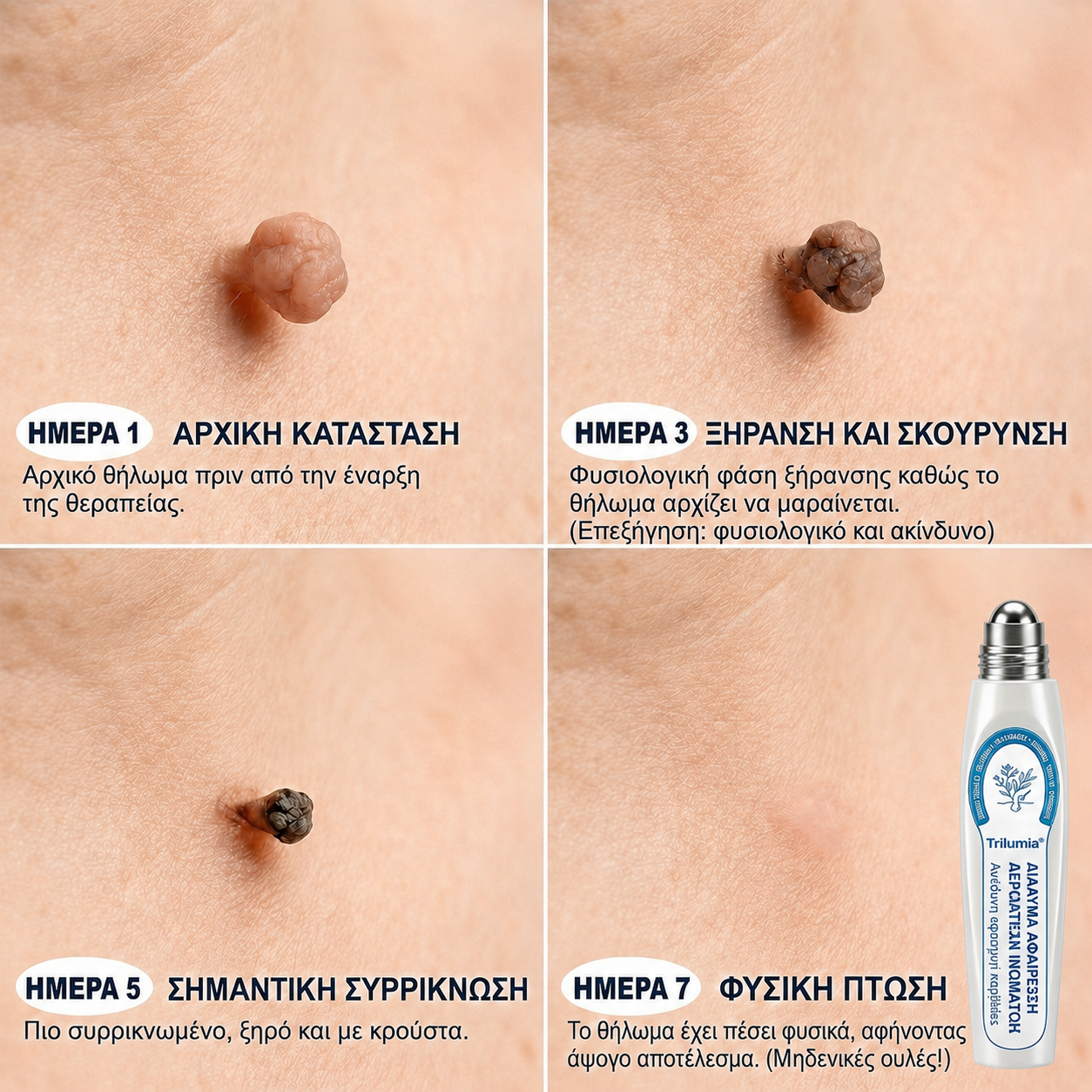𝑻𝒓𝒊𝒍𝒖𝒎𝒊𝒂® 💎 Premium Στυλό Roller | Αφαίρεση για Μυρμηγκιές, Ελιές & Κηλίδες 🇬🇷