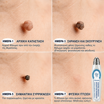 𝑻𝒓𝒊𝒍𝒖𝒎𝒊𝒂® 💎 Premium Στυλό Roller | Αφαίρεση για Μυρμηγκιές, Ελιές & Κηλίδες 🇬🇷