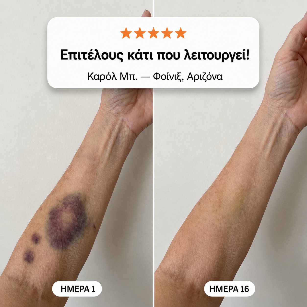 💥+100K Πουλήθηκαν❤️ - CureVivo® Κρέμα για Μελανιές και Ενδυνάμωση του Δέρματος